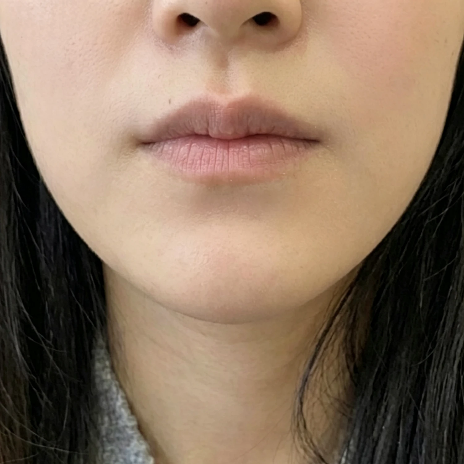 After — Case A — Chin