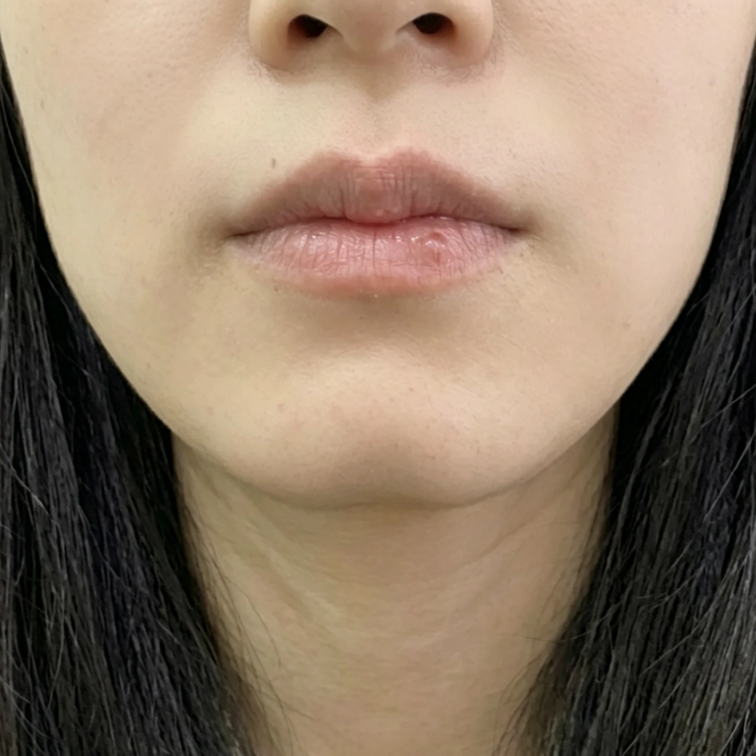 Before — Case A — Chin