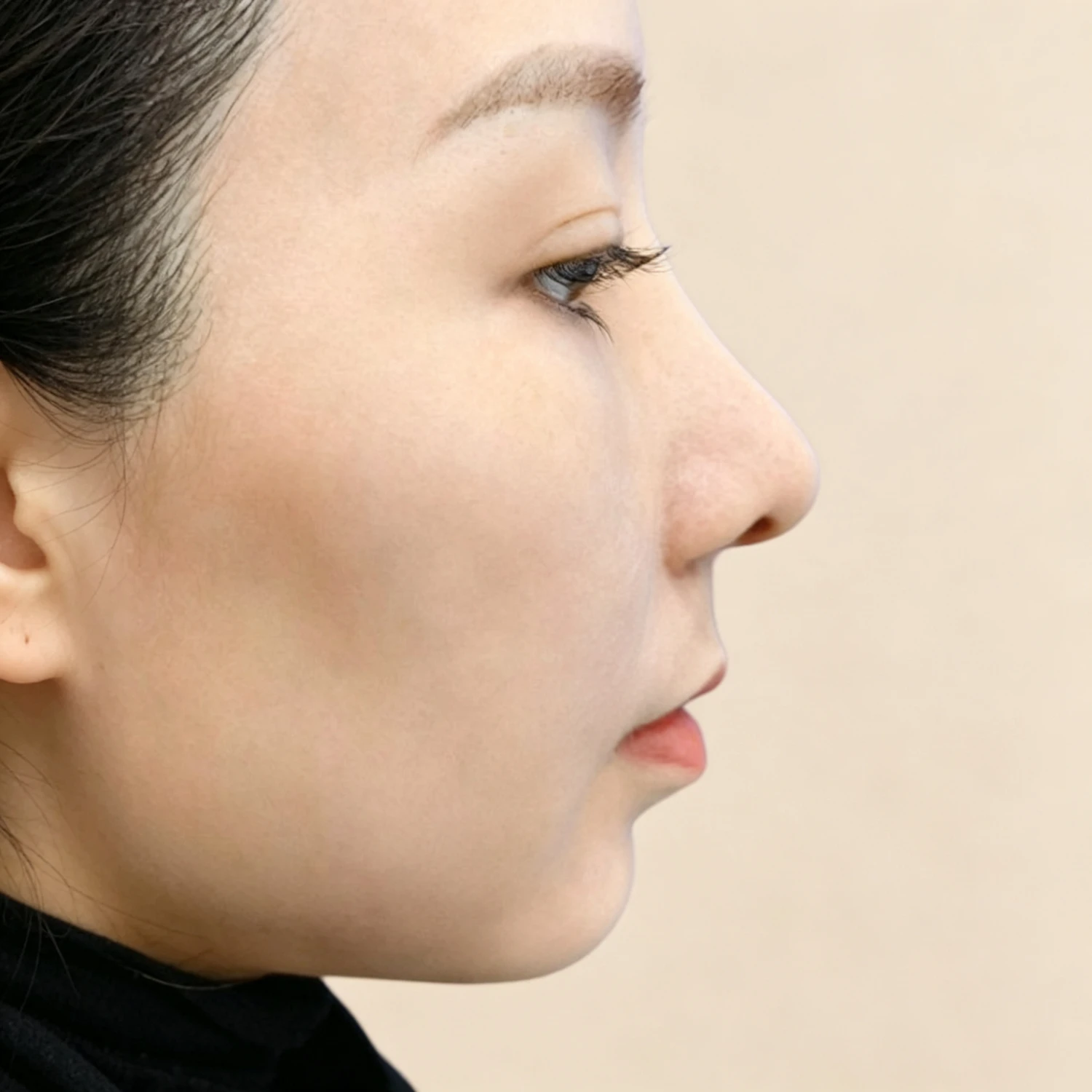 Before — Case B — Chin