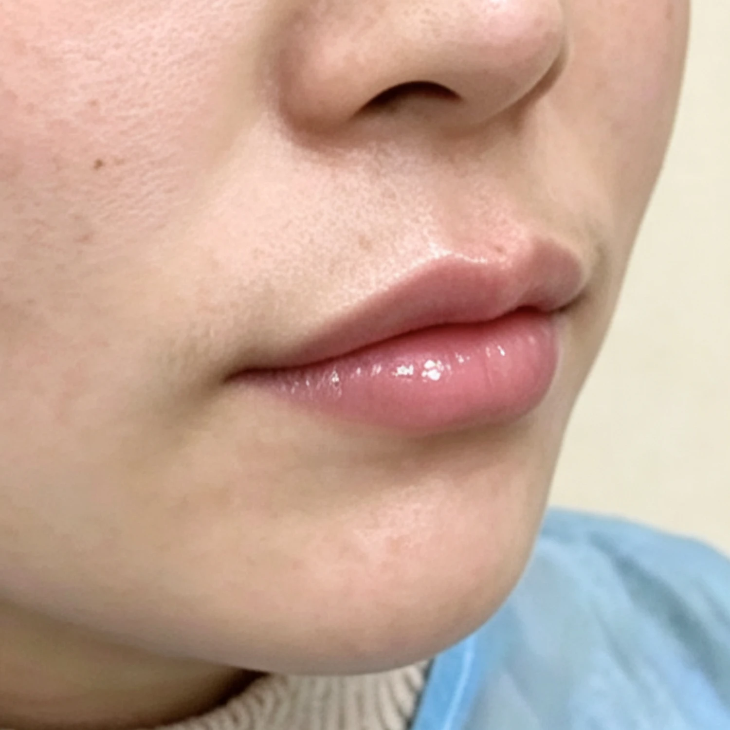 After — Lip Fullness — Lip