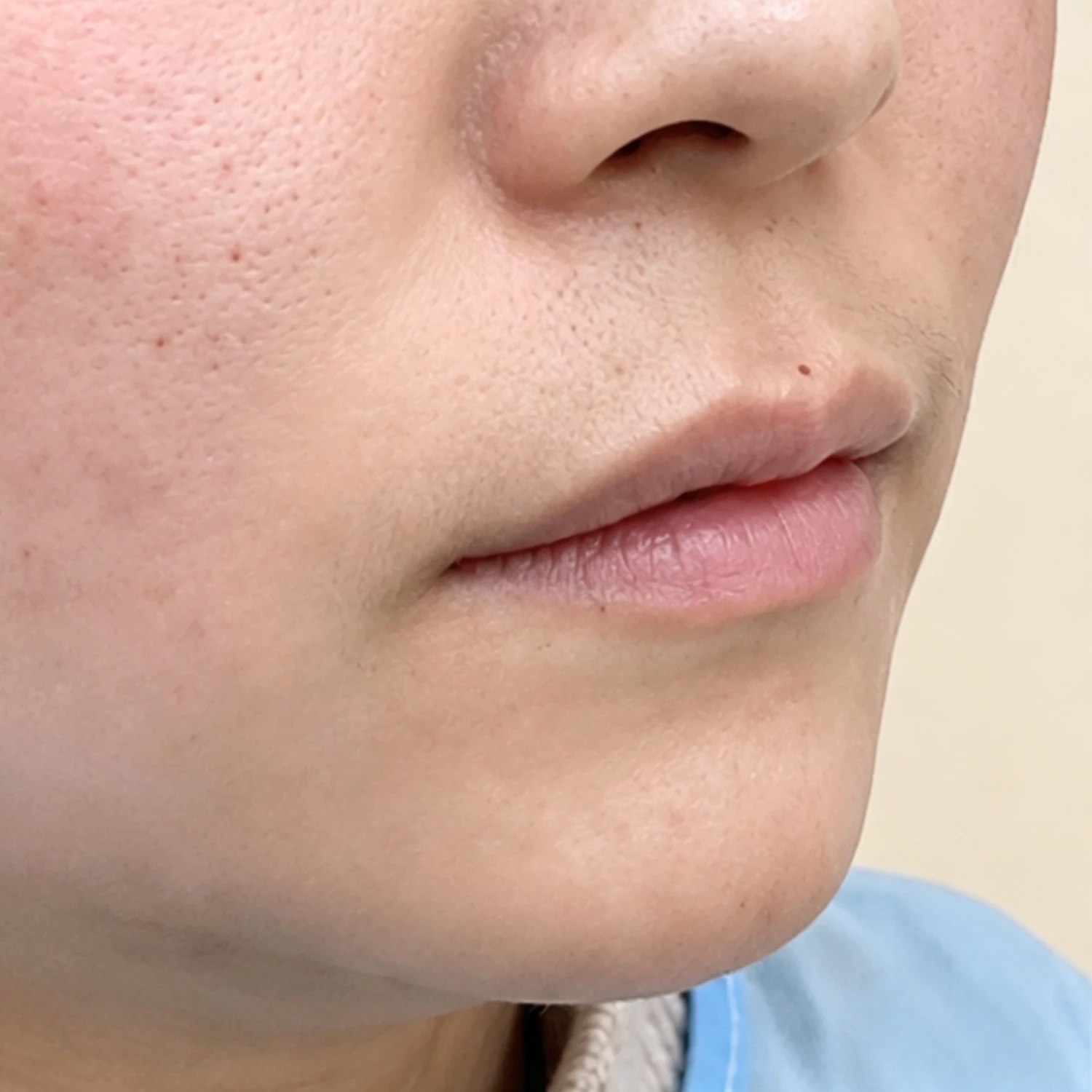 Before — Lip Fullness — Lip