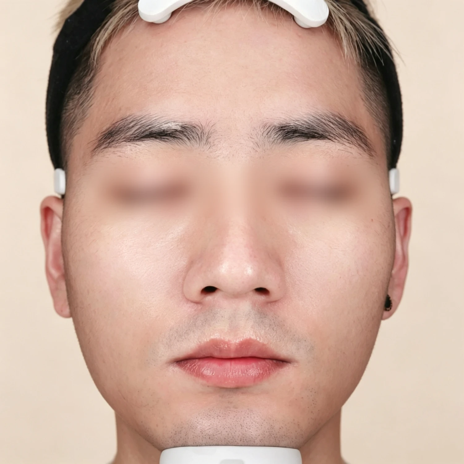 After — Case A — Mesoderm