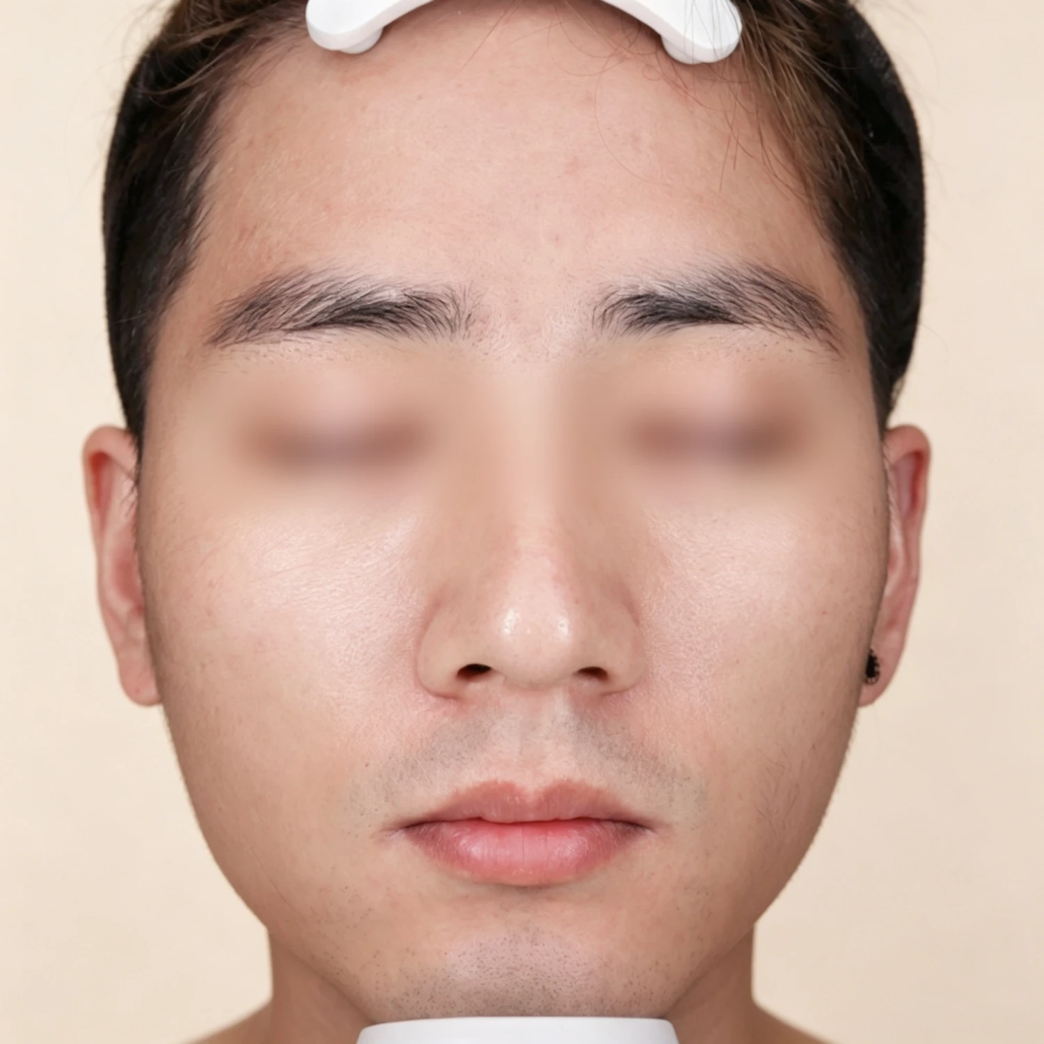 Before — Case A — Mesoderm