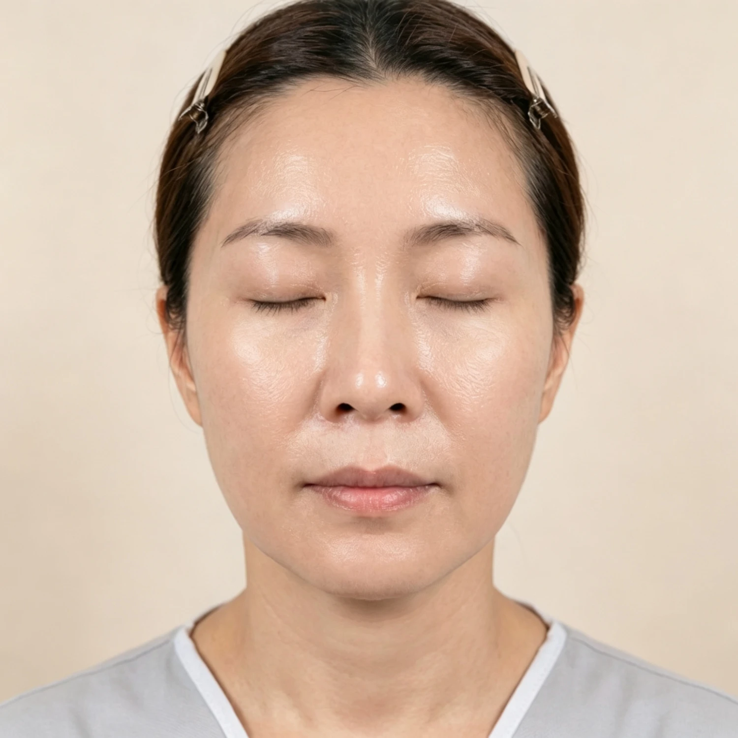 After — Case B — Mesoderm