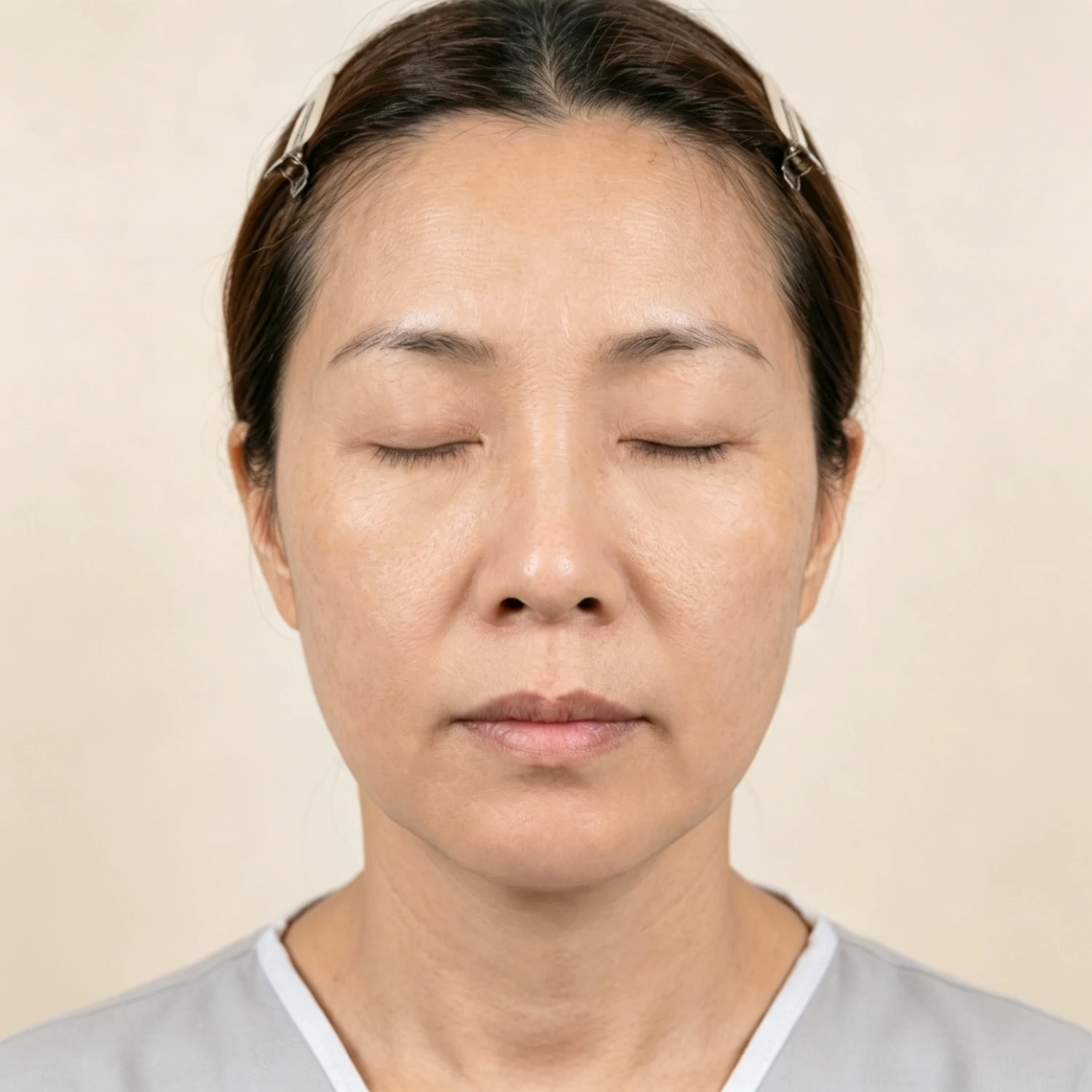 Before — Case B — Mesoderm