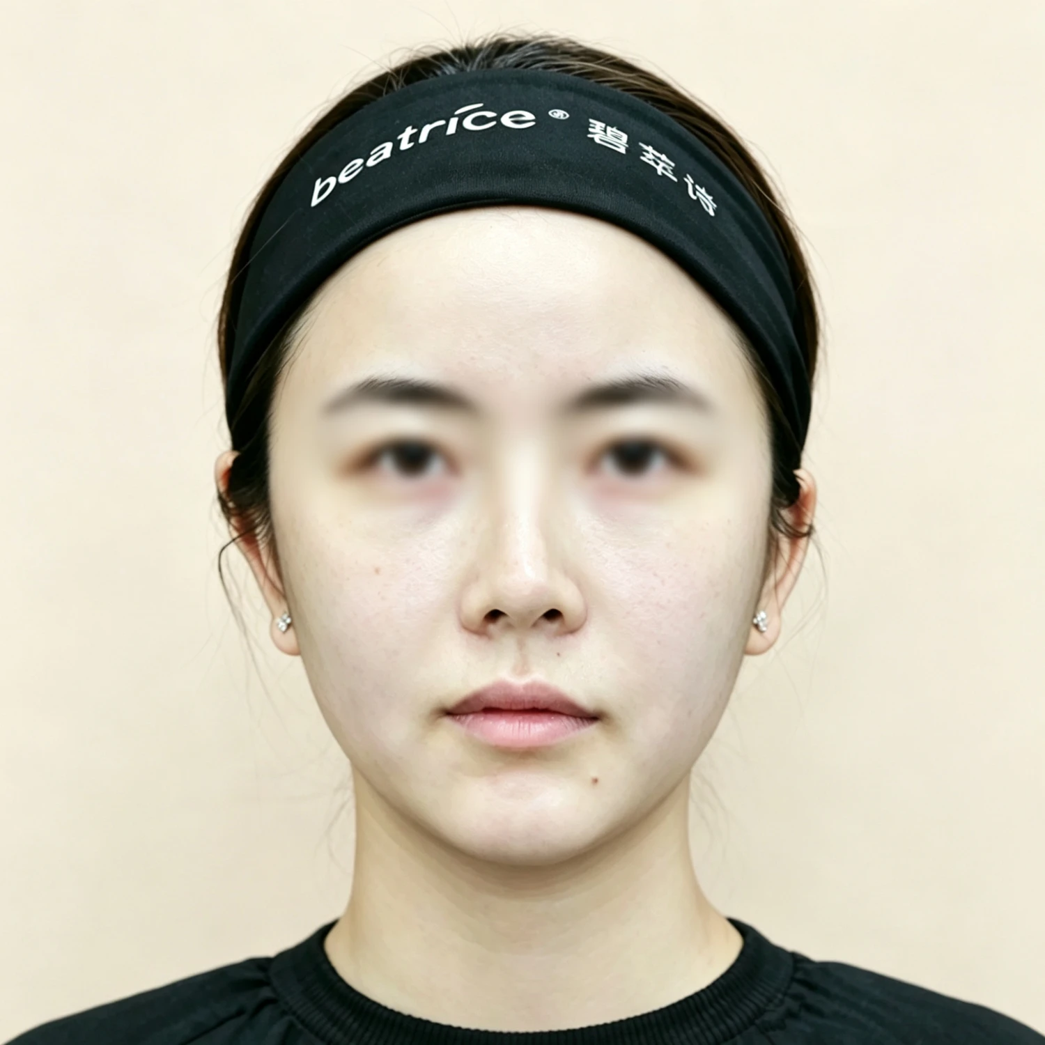 After — Nasolabial folds and marionette lines treatment case