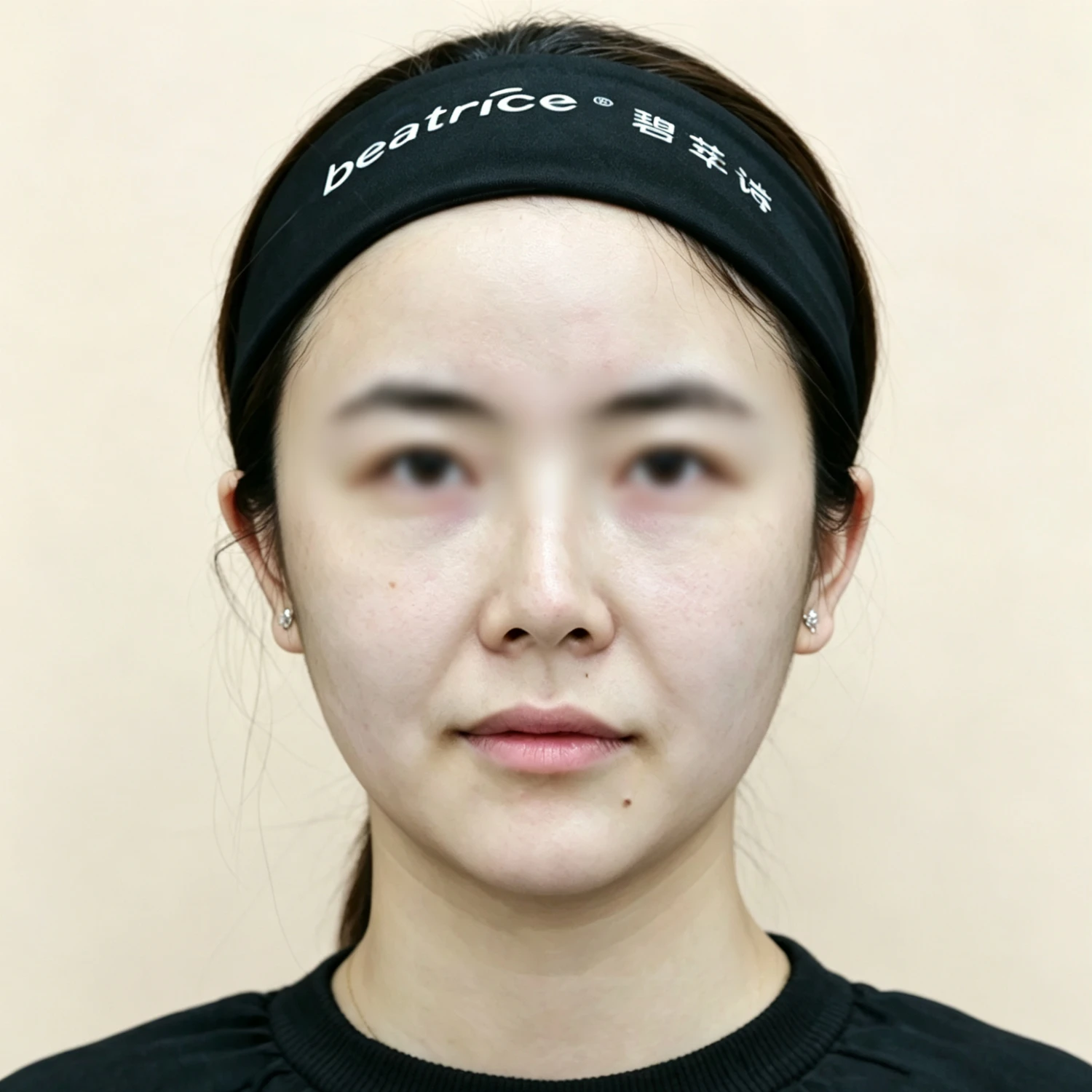 Before — Nasolabial folds and marionette lines treatment case