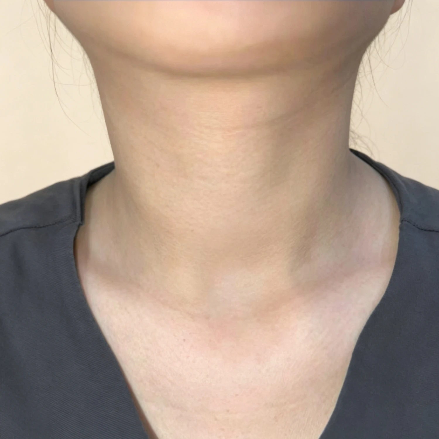 After — Case B — Neck
