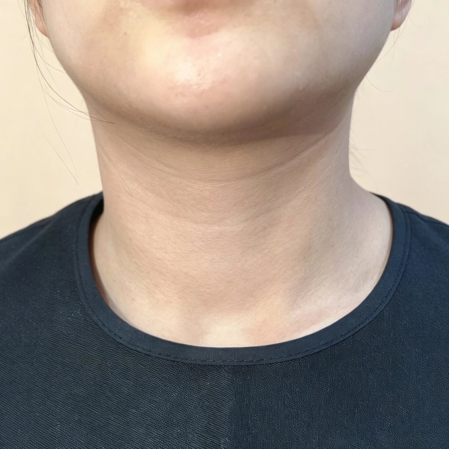Before — Case B — Neck